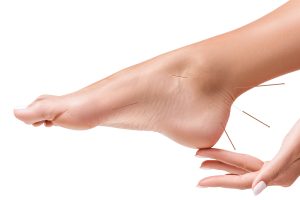 Female legs with insert acupuncture needles. Acupuncture treatment concept.